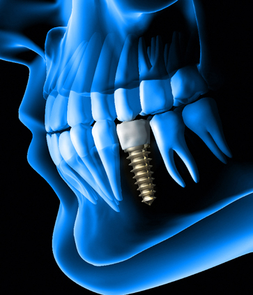 Treatment - 2 Green Dental