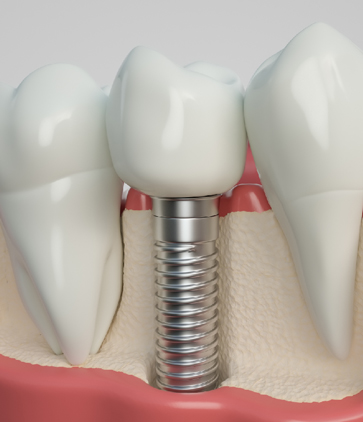 Treatment - 2 Green Dental