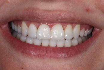 After - 2 Green Dental