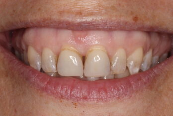 Before - 2 Green Dental