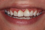 Before - 2 Green Dental