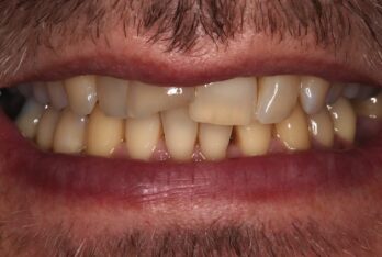Before - 2 Green Dental