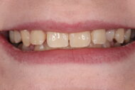 Before - 2 Green Dental