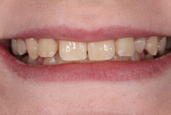 Before - 2 Green Dental