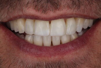 After - 2 Green Dental