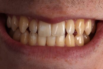 Before - 2 Green Dental