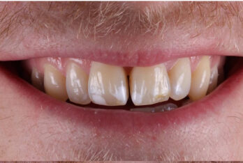 Before - 2 Green Dental