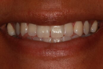 Before - 2 Green Dental