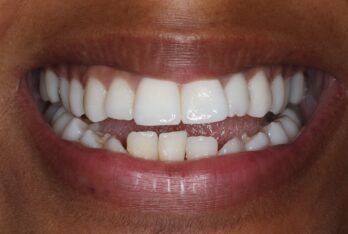 Before - 2 Green Dental