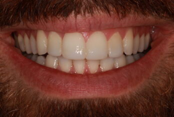 After - 2 Green Dental