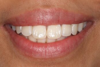 Before - 2 Green Dental