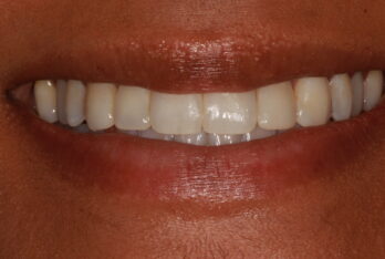 After - 2 Green Dental