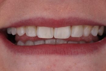 After - 2 Green Dental