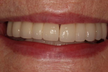 After - 2 Green Dental