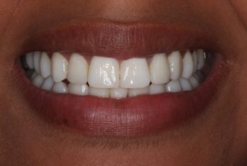 After - 2 Green Dental