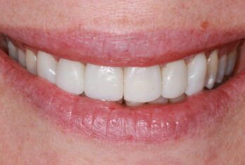 After - 2 Green Dental